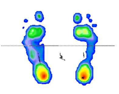 Analyse des pressions plantaires
